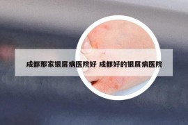 成都那家银屑病医院好 成都好的银屑病医院