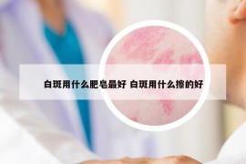 白斑用什么肥皂最好 白斑用什么擦的好