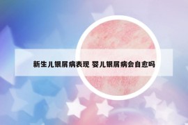 新生儿银屑病表现 婴儿银屑病会自愈吗