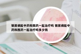 银屑病能中药和西药一起治疗吗 银屑病能中药和西药一起治疗吗多少钱