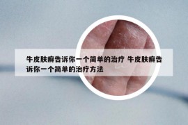 牛皮肤癣告诉你一个简单的治疗 牛皮肤癣告诉你一个简单的治疗方法
