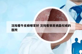 沈阳看牛皮癣哪家好 沈阳看银屑病最权威的医院
