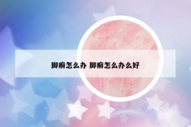 脚癣怎么办 脚癣怎么办么好