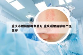 重庆市银屑病哪家最好 重庆看银屑病哪个医生好