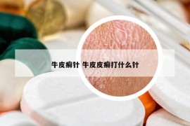 牛皮癣针 牛皮皮癣打什么针