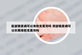 脸部银屑病可以用他克莫司吗 阴部银屑病可以长期用他克莫司吗