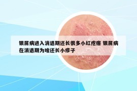 银屑病进入消退期还长很多小红疙瘩 银屑病在消退期为啥还长小疹子