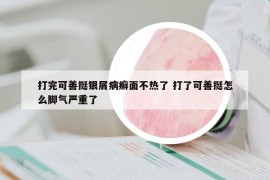 打完可善挺银屑病癣面不热了 打了可善挺怎么脚气严重了