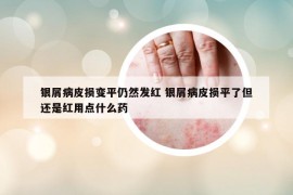 银屑病皮损变平仍然发红 银屑病皮损平了但还是红用点什么药