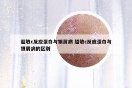超敏c反应蛋白与银屑病 超敏c反应蛋白与银屑病的区别