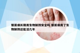 银屑病长期用生物制剂安全吗 银屑病用了生物制剂还能活几年
