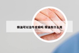 棉油可以治牛皮癣吗 棉油有什么用