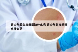 青少年起头皮癣是缺什么吗 青少年头皮癣擦点什么药