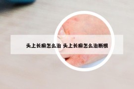 头上长癣怎么治 头上长癣怎么治断根