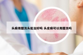 头癣用醋洗头能治好吗 头皮癣可以用醋洗吗
