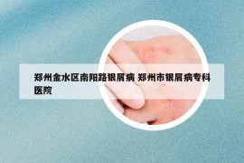 郑州金水区南阳路银屑病 郑州市银屑病专科医院