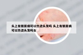 头上有银屑病可以热烫头发吗 头上有银屑病可以热烫头发吗女