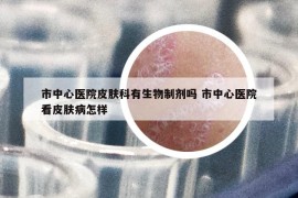 市中心医院皮肤科有生物制剂吗 市中心医院看皮肤病怎样
