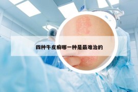 四种牛皮癣哪一种是最难治的