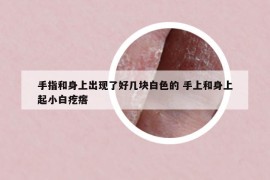 手指和身上出现了好几块白色的 手上和身上起小白疙瘩