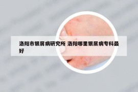 洛阳市银屑病研究所 洛阳哪里银屑病专科最好