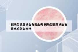 斑块型银屑病会有黄水吗 斑块型银屑病会有黄水吗怎么治疗