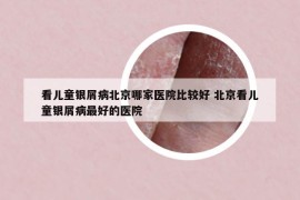 看儿童银屑病北京哪家医院比较好 北京看儿童银屑病最好的医院