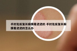 手肘处反复长癣摸着烫烫的 手肘处反复长癣摸着烫烫的怎么办