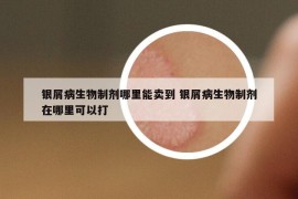 银屑病生物制剂哪里能卖到 银屑病生物制剂在哪里可以打