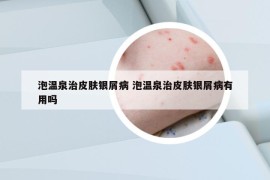 泡温泉治皮肤银屑病 泡温泉治皮肤银屑病有用吗
