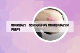 银屑病伤口一定会变成藓吗 银屑病有伤口会传染吗