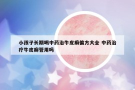 小孩子长期喝中药治牛皮癣偏方大全 中药治疗牛皮癣管用吗