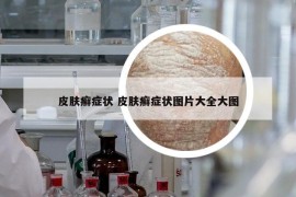 皮肤癣症状 皮肤癣症状图片大全大图