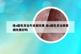 维a酸乳膏治牛皮癣效果 维a酸乳膏治银屑病效果好吗