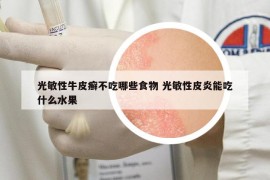 光敏性牛皮癣不吃哪些食物 光敏性皮炎能吃什么水果