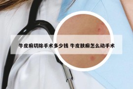 牛皮癣切除手术多少钱 牛皮肤癣怎么动手术