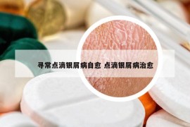 寻常点滴银屑病自愈 点滴银屑病治愈