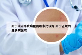 南宁诊治牛皮癣医院哪家比较好 南宁正规的皮肤病医院
