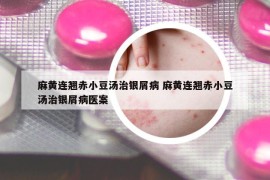 麻黄连翘赤小豆汤治银屑病 麻黄连翘赤小豆汤治银屑病医案