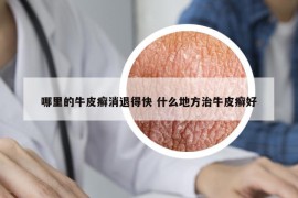 哪里的牛皮癣消退得快 什么地方治牛皮癣好