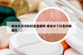 嘴角长淡淡的红色是癣吗 嘴角长了红色的癣图片