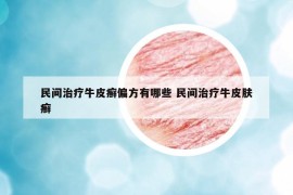 民间治疗牛皮癣偏方有哪些 民间治疗牛皮肤癣