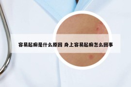 容易起癣是什么原因 身上容易起癣怎么回事