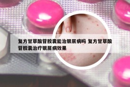 复方甘草酸苷胶囊能治银屑病吗 复方甘草酸苷胶囊治疗银屑病效果