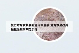复方木尼孜其颗粒能治银屑病 复方木尼孜其颗粒治银屑病怎么样