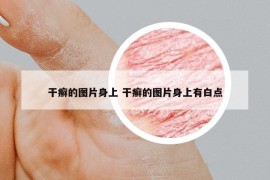 干癣的图片身上 干癣的图片身上有白点