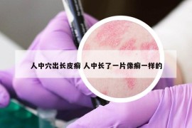 人中穴出长皮癣 人中长了一片像癣一样的