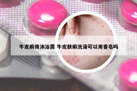 牛皮癣用沐浴露 牛皮肤癣洗澡可以用香皂吗
