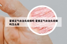 藿香正气水治头皮癣吗 藿香正气水治头皮癣吗怎么用