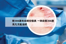 照308激光白斑价格表 一块白斑308激光几次能治好